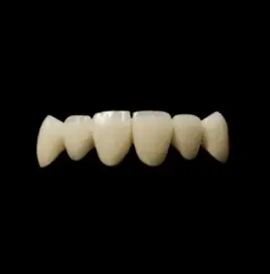 Porcelain Fused to Metal