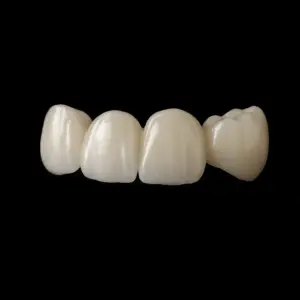 Close-up of four artificial teeth (veneers) aligned in a row against a black background, showcasing smooth enamel and natural shape.