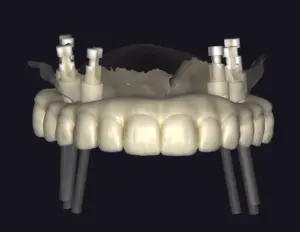 dentures